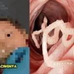 Tragedi Balita Sukabumi: Tertular Cacing Parasit Parah