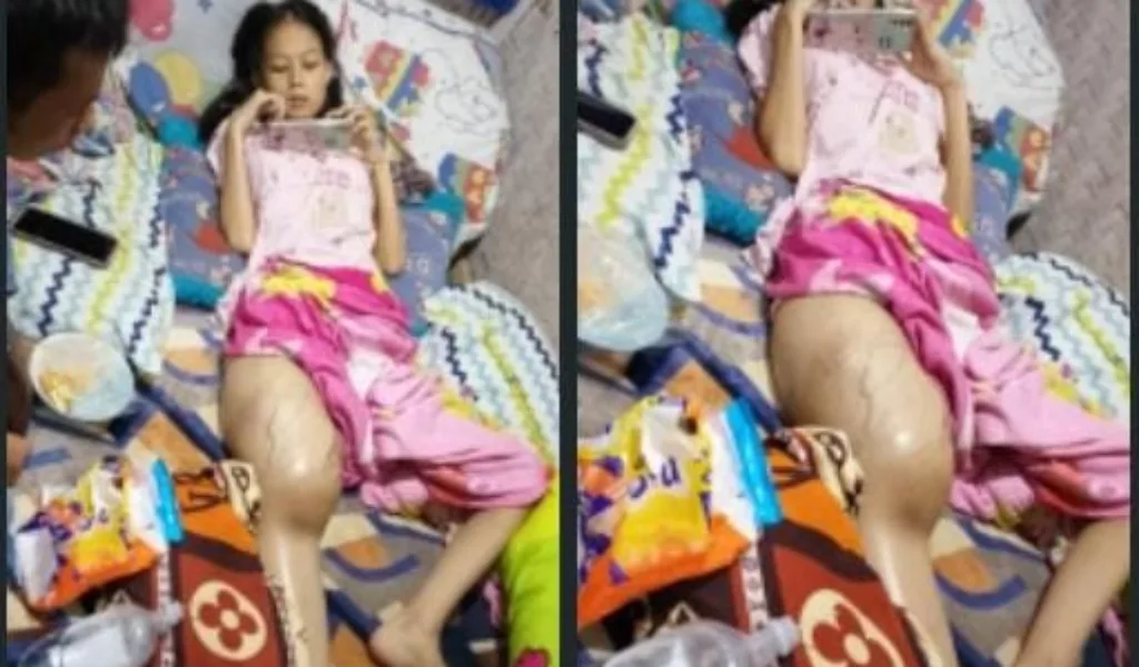 Siswi Di Garut Alami Komplikasi Pasca Oprasi, Warga Harpkan Perhatian Serius Pemda